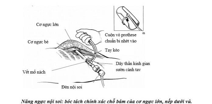 3 phương pháp trùng tu vòng 1 hot nhất hiện nay và những lưu ý quan trọng-2
