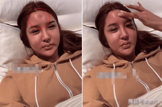 Hot girl 3 triệu follow trán lõm, mặt sưng phù do dao kéo quá đà-2