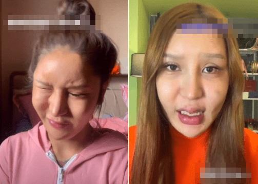 Hot girl 3 triệu follow trán lõm, mặt sưng phù do dao kéo quá đà-4