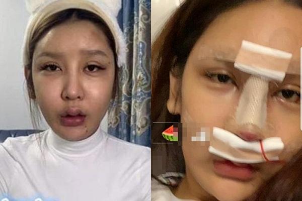 Hot girl 3 triệu follow trán lõm, mặt sưng phù do dao kéo quá đà-5