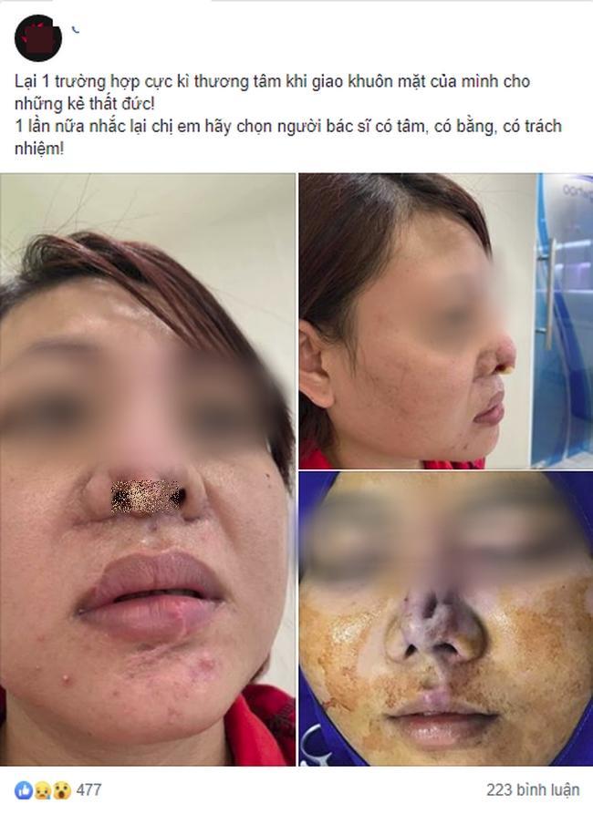 Hot girl 3 triệu follow trán lõm, mặt sưng phù do dao kéo quá đà-6