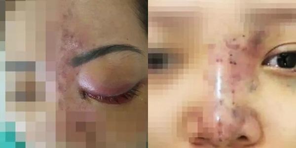 Hot girl 3 triệu follow trán lõm, mặt sưng phù do dao kéo quá đà-8