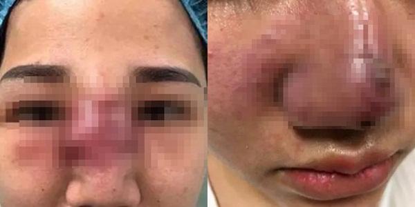 Hot girl 3 triệu follow trán lõm, mặt sưng phù do dao kéo quá đà-9