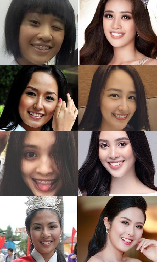 Mai Phương Thúy đẹp lên nhờ niềng răng: Sự thật có phải vậy?-1