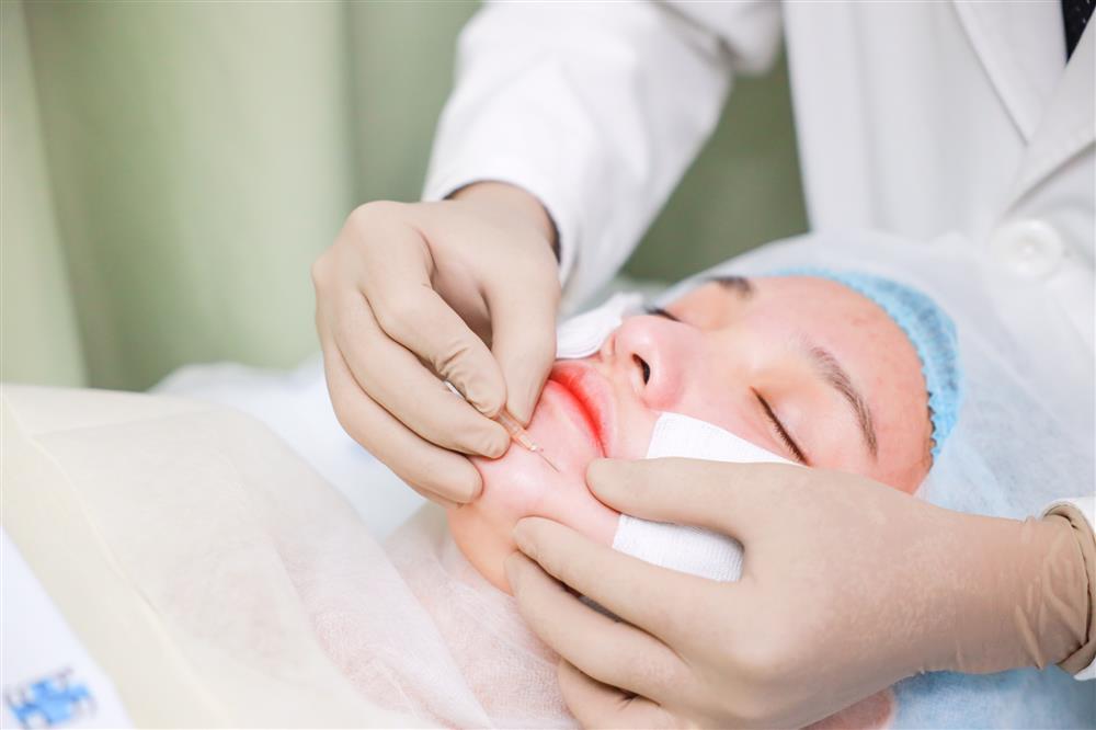 Từ A-Z về cấy chỉ căng da mặt - phương pháp trẻ hóa dung nhan đang hot rần rần-7