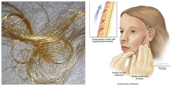 Từ A-Z về cấy chỉ căng da mặt - phương pháp trẻ hóa dung nhan đang hot rần rần-1
