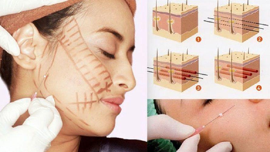 Từ A-Z về cấy chỉ căng da mặt - phương pháp trẻ hóa dung nhan đang hot rần rần-2