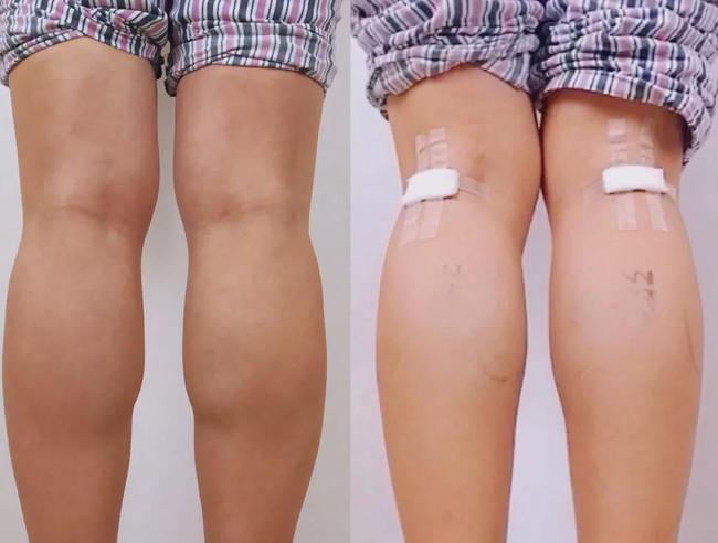 Nhiều cô gái Trung Quốc cắt dây thần kinh để sở hữu bắp chân thon-2