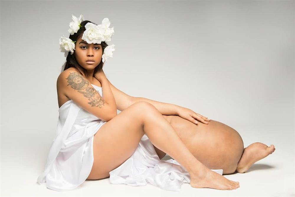 Người mẫu có chân trái sưng phù: Tôi đẹp từ trong ra ngoài-1