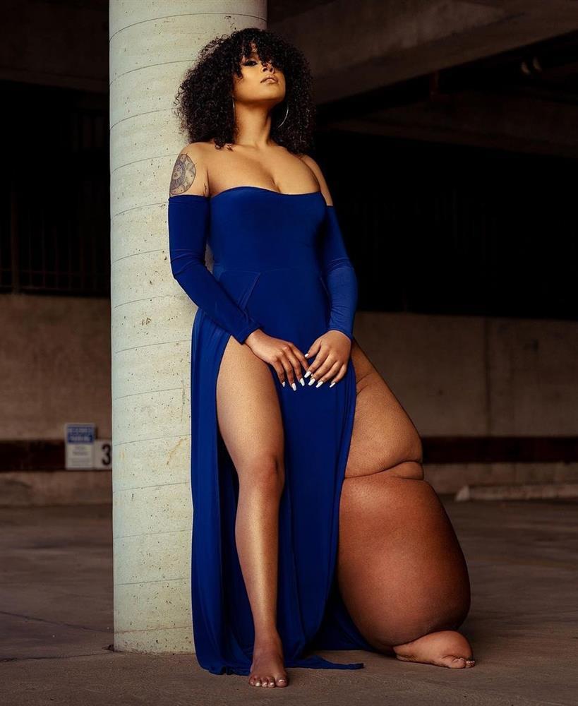 Người mẫu có chân trái sưng phù: Tôi đẹp từ trong ra ngoài-3