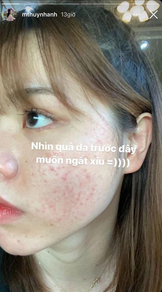 Bồ cũ Quang Hải lộ mặt chi chít mụn, ai nhìn cũng hãi hùng-1