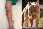 Thấy chó Pitbull ngậm chặt chân con trai, người bố lao vào ứng cứu bị cắn đứt 1 ngón tay
