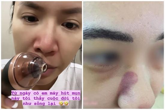 Máy hút mụn cầm tay đang hot: 10 điểm tiện lợi nhưng cần cẩn trọng!