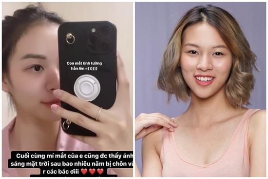 Phí Phương Anh lên hương nhan sắc nhờ phương pháp nhấn mí Plasma không 'dao kéo'