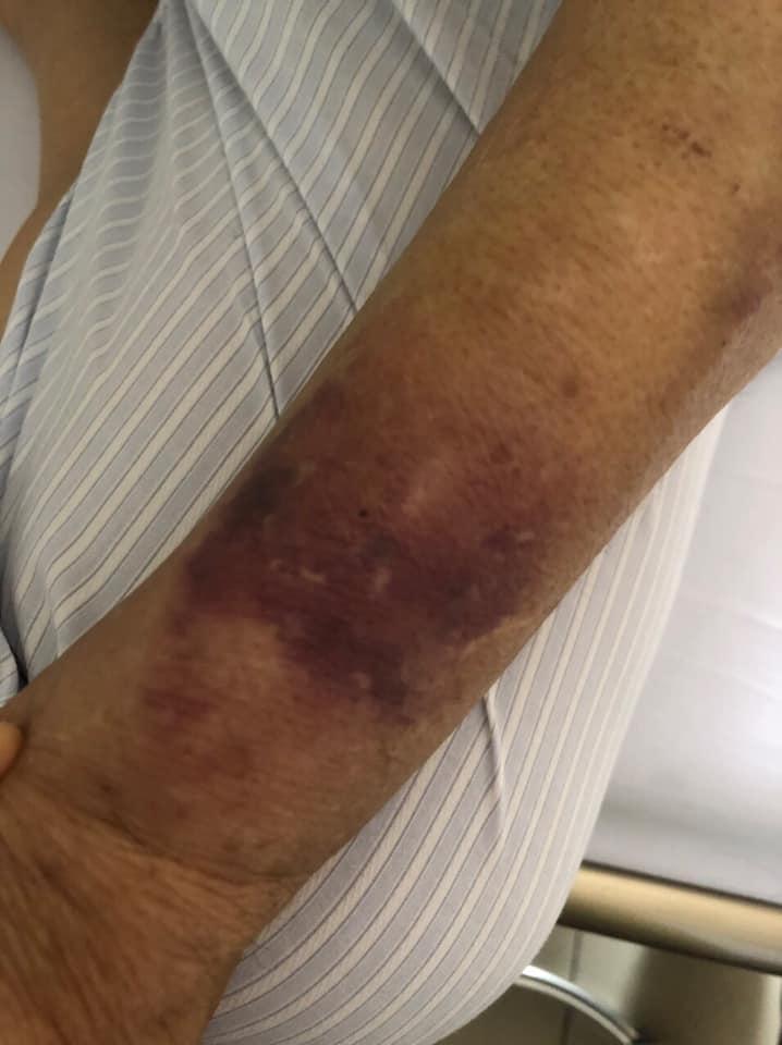 Giang Còi lạc quan dù bệnh nặng, phải lấy ven chân vì tay sưng to bầm tím-2