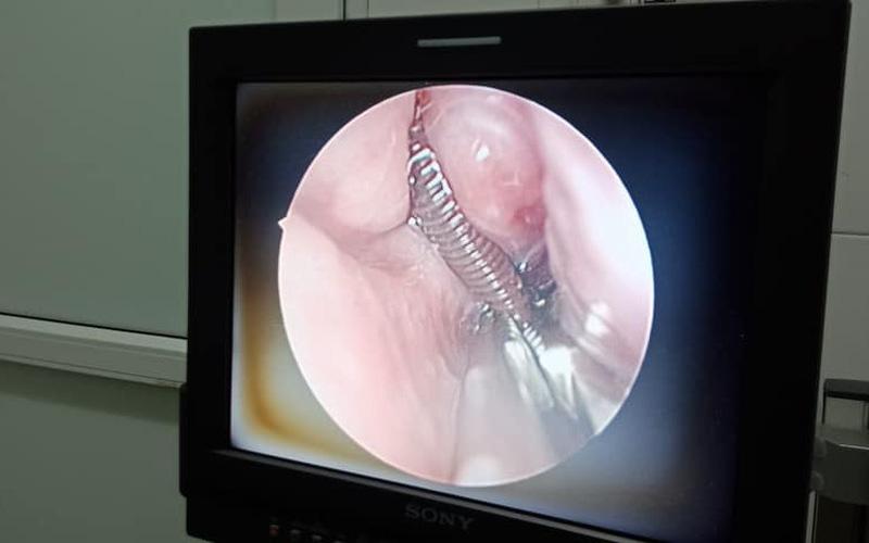 Rùng mình: Con đỉa to như đầu đũa làm tổ trong mũi người phụ nữ ở Cao Bằng-1