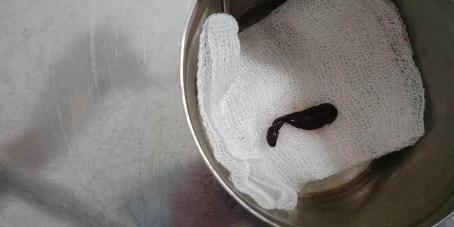 Rùng mình: Con đỉa to như đầu đũa làm tổ trong mũi người phụ nữ ở Cao Bằng-2