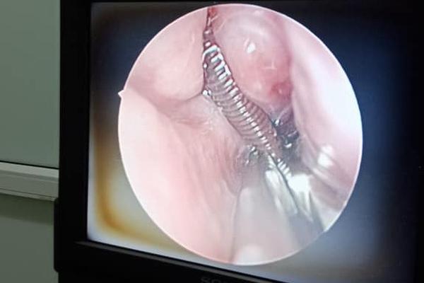 Bé 8 tuổi liên tục chảy máu do đỉa chui vào người sau buổi tắm ao-2