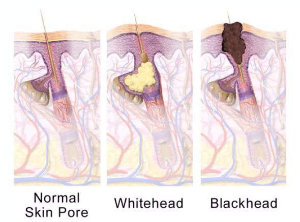 Mụn đầu đen mọc tái mọc hồi ở mũi, đâu là nguyên nhân và cách khắc phục-3