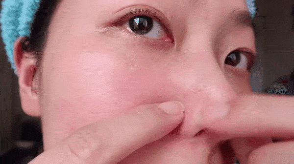 Mụn đầu đen mọc tái mọc hồi ở mũi, đâu là nguyên nhân và cách khắc phục-5