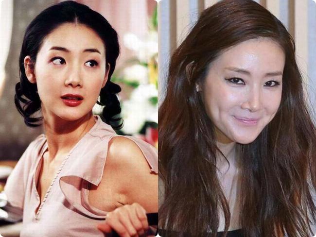 Người đẹp khóc Choi Ji Woo: Từng có giai đoạn mặt sưng phù cứng đơ vì tiêm Botox-4