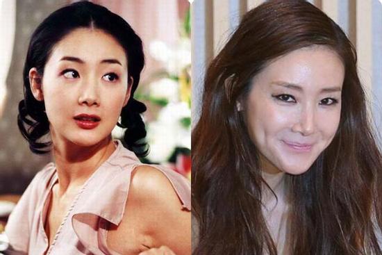 'Người đẹp khóc' Choi Ji Woo: Từng có giai đoạn mặt sưng phù cứng đơ vì tiêm Botox