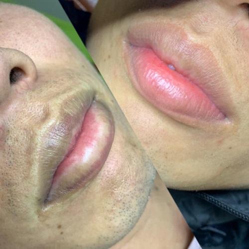 Trốn vợ đi xăm môi khử thâm, ông chú râu rậm rịt, mồm đỏ choét-7