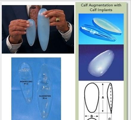 Hết hồn quy trình độn bắp chân silicon dành cho người cẳng gà-7