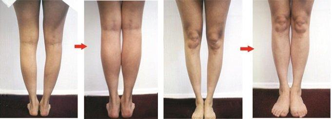 Hết hồn quy trình độn bắp chân silicon dành cho người cẳng gà-6