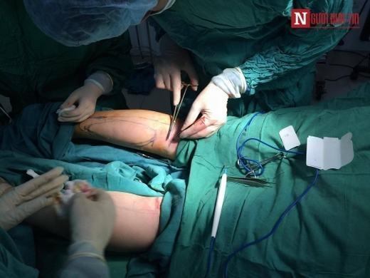 Hết hồn quy trình độn bắp chân silicon dành cho người cẳng gà-9