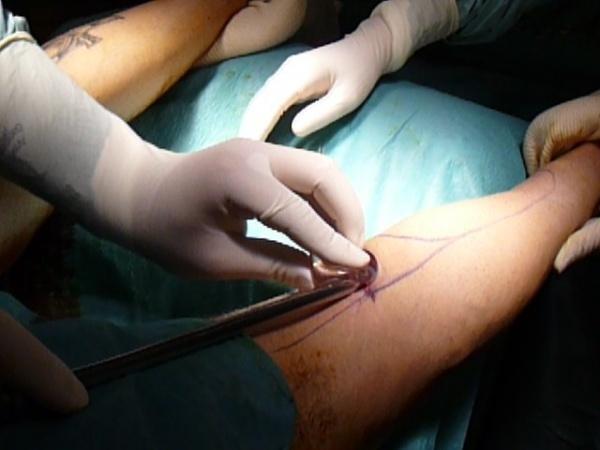 Hết hồn quy trình độn bắp chân silicon dành cho người cẳng gà-10