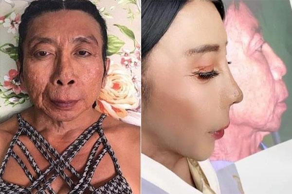 Gương mặt nhàu của gái già chuyển giới có thật sự được cải thiện?-8