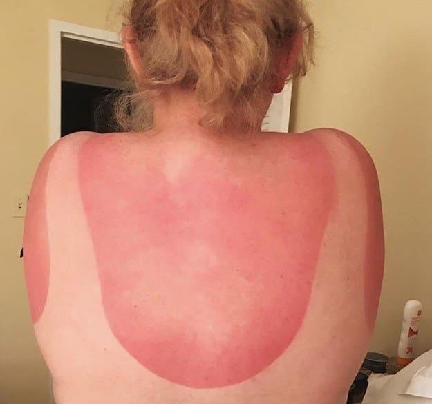 Chiến tích cháy nắng thê lương khiến bạn chỉ muốn ruồng rẫy mùa hè-5