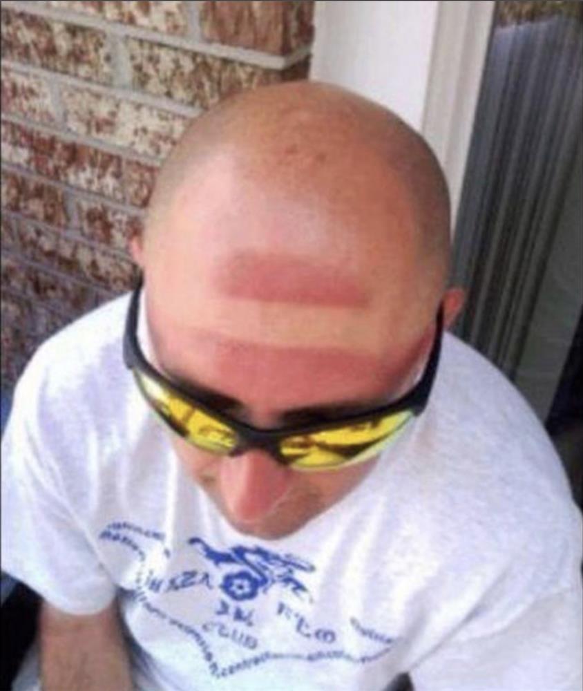 Chiến tích cháy nắng thê lương khiến bạn chỉ muốn ruồng rẫy mùa hè-6