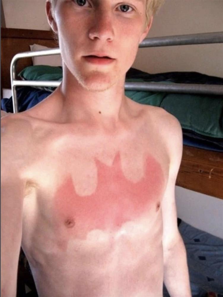 Chiến tích cháy nắng thê lương khiến bạn chỉ muốn ruồng rẫy mùa hè-9