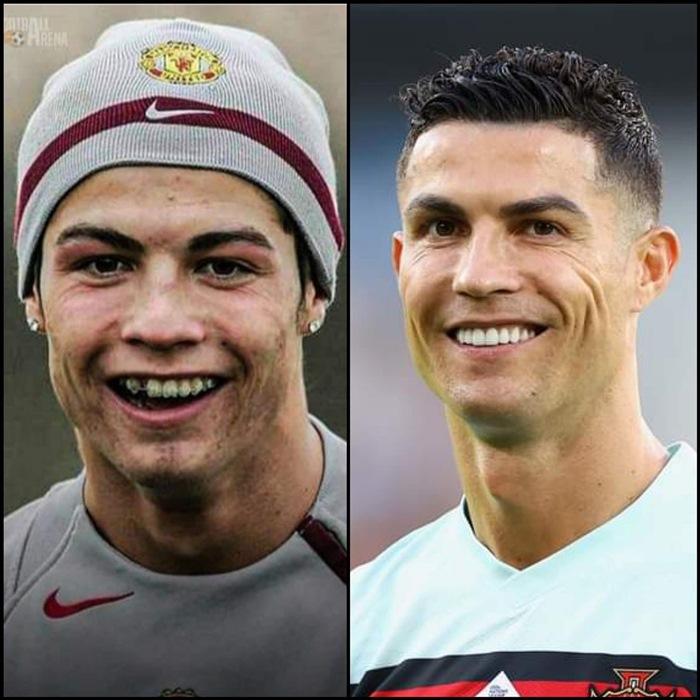 Để sở hữu vẻ điển trai, phong độ như hiện tại, ít ai biết rằng cầu thủ Ronaldo đã từng một thời lột xác nhờ niềng răng.