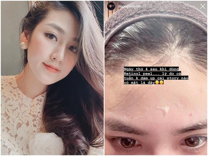 Á hậu Tú Anh toang mặt vì dùng hoạt chất Retinol peel da-2
