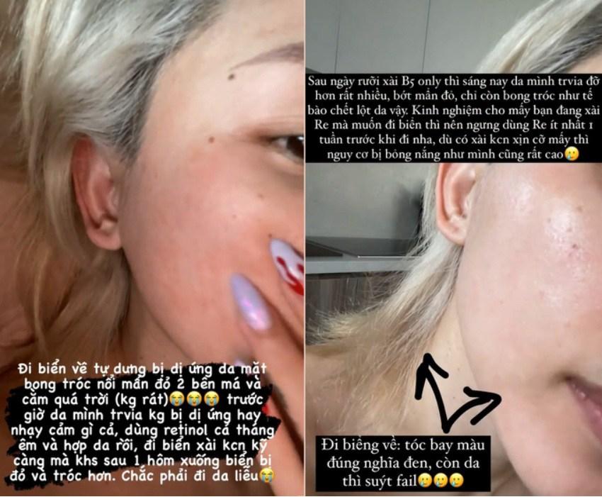 Á hậu Tú Anh toang mặt vì dùng hoạt chất Retinol peel da-5
