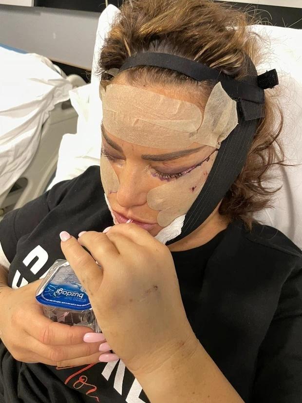 Người mẫu xứ Anh nghiện thẩm mỹ: Cả người cắm đầy ống dịch, mặt biến dạng-4