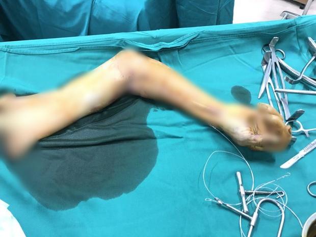 Rùng mình: Người phụ nữ 58 tuổi bị máy cưa cắt lìa cánh tay phải-1