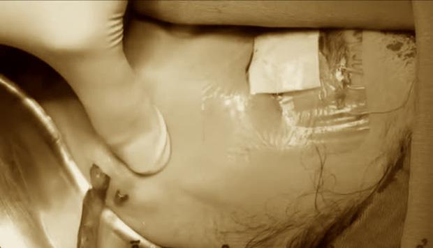 Cô gái 24 tuổi bị nhiễm trùng vùng mặt nghiêm trọng sau 3 năm tiêm filler-1