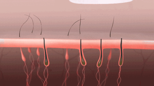 Sự thật các phương pháp triệt lông bôi mỡ trăn, wax, chiếu IPL/laser-5