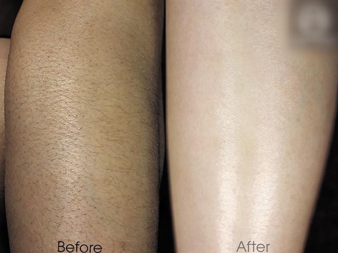 Sự thật các phương pháp triệt lông bôi mỡ trăn, wax, chiếu IPL/laser-3