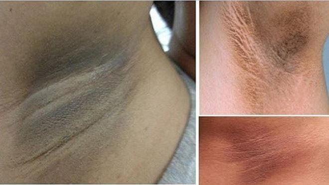 Sự thật các phương pháp triệt lông bôi mỡ trăn, wax, chiếu IPL/laser-1
