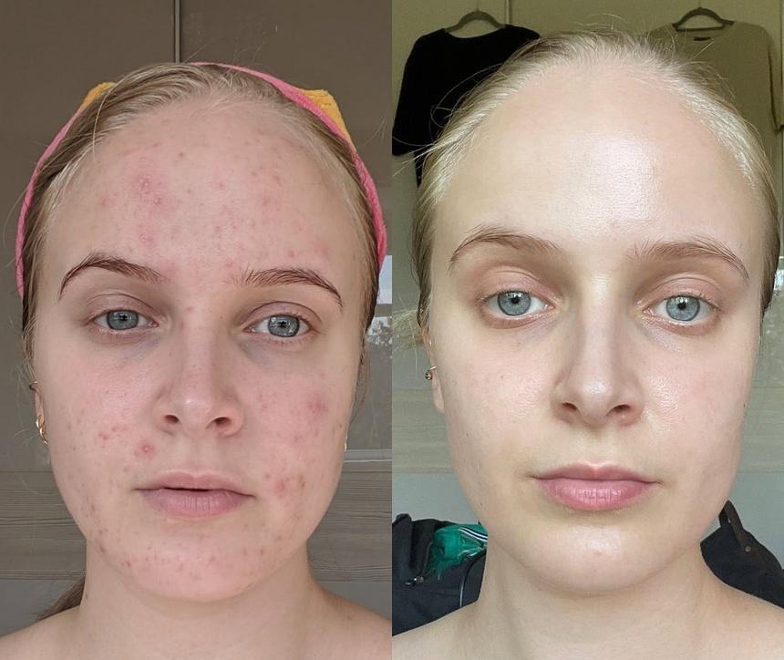 Lên mụn đầy mặt vì dùng thuốc tránh thai-1