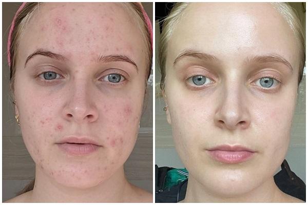 Tại sao phụ nữ thường bị nổi mụn kín lưng?-4