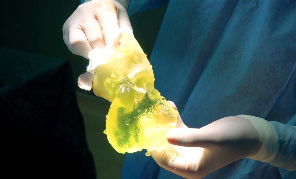 Đi độ loa, Rich Kid chuyển giới phát hiện túi silicon cũ vỡ toang-2