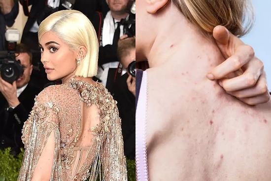 Tại sao phụ nữ thường bị nổi mụn kín lưng?