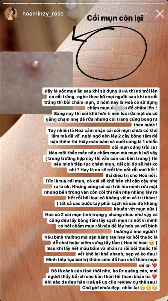 Hòa Minzy nổi mụn thê thảm sau khi triệt lông mặt-3