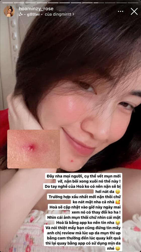 Hòa Minzy nổi mụn thê thảm sau khi triệt lông mặt-4